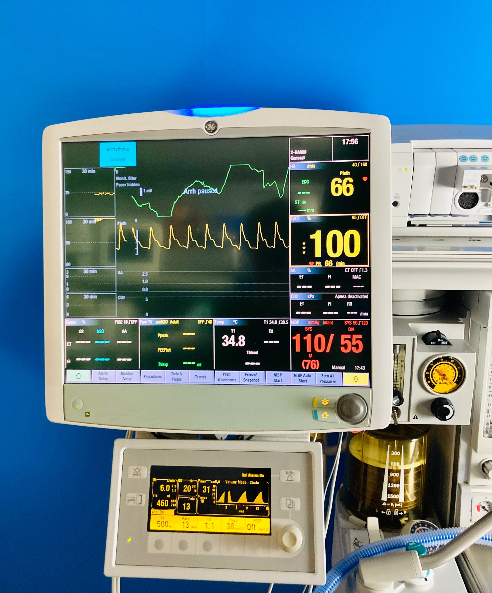 Auto View on Alarm (AVOA) automatically shares high priority alarms within the care unit, CARESCAPE Patient Data Module provides consistent hemodynamic measurement during intra-hospital transport and also transfers trend data