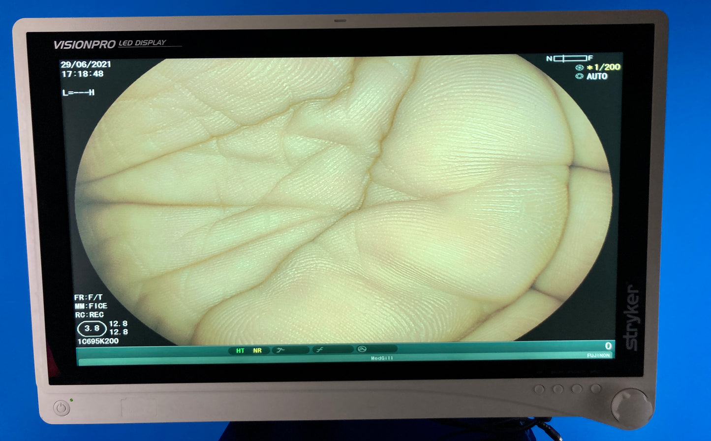 LCD monitor Video center Endoscope Visualization System displays