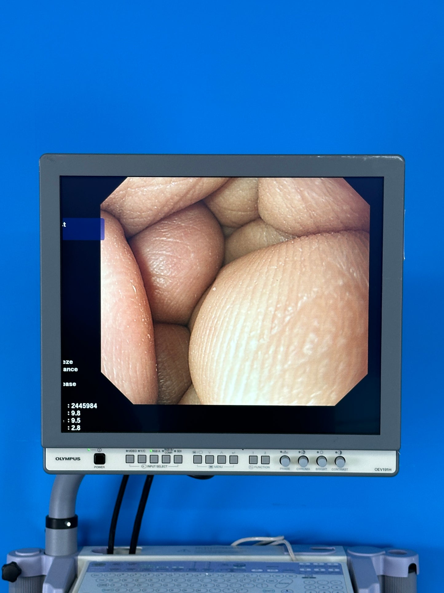 Olympus LCD Monitor shows Excellent display of the endoscope view