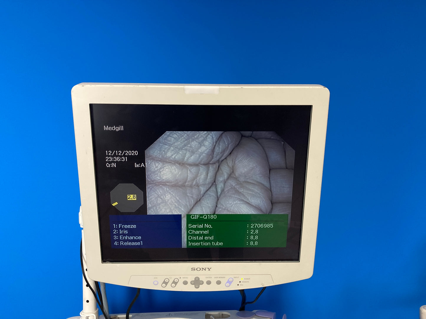 Sony LCD Monitor Widest field of view available in a Gastroscope , Full screen display size give superior image quality