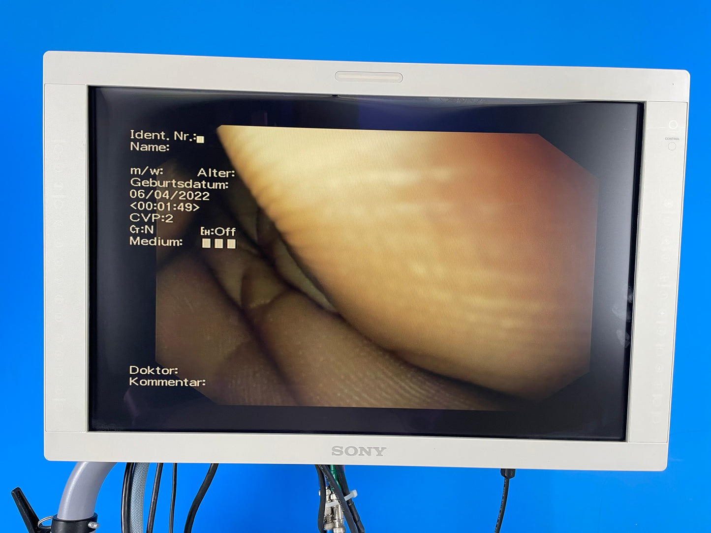 Sony LCD Monitor Widest field of view available in a colonoscope, 170 degrees Full screen display size give superior image quality
