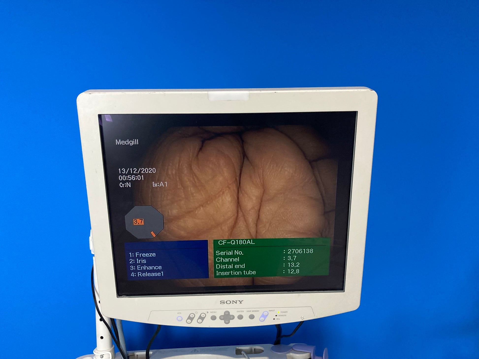 Sony LCD Monitor Widest field of view available in a colonoscope, 170 degrees Full screen display size give superior image quality