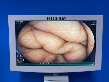 LCD Monitor Widest field of view available in a colonoscope, 170 degrees Full screen display size give superior image quality