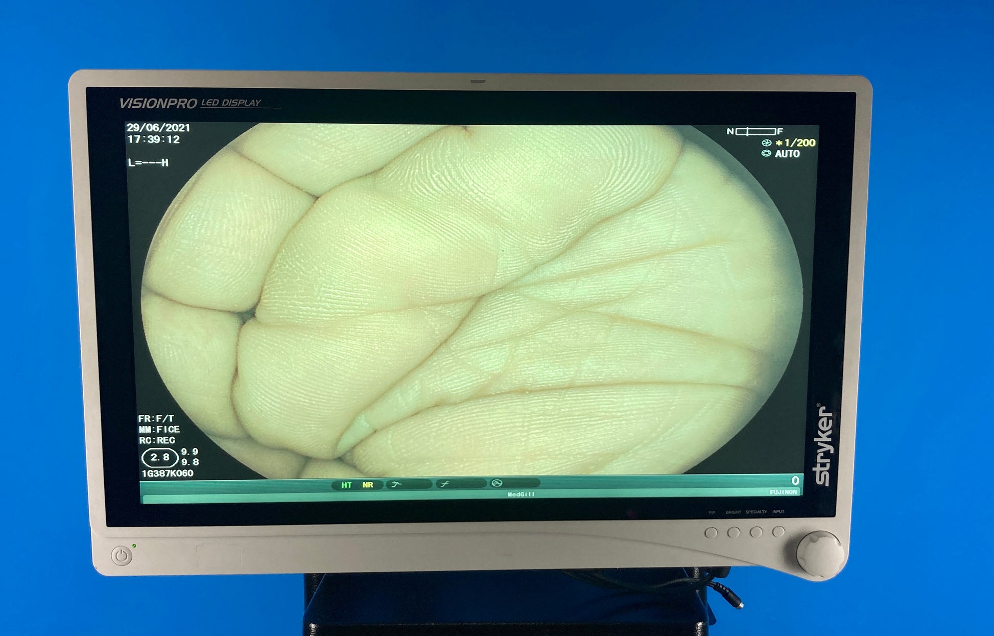 Stryker Visionpro LED Monitor Video center show the surgical Procedure 
