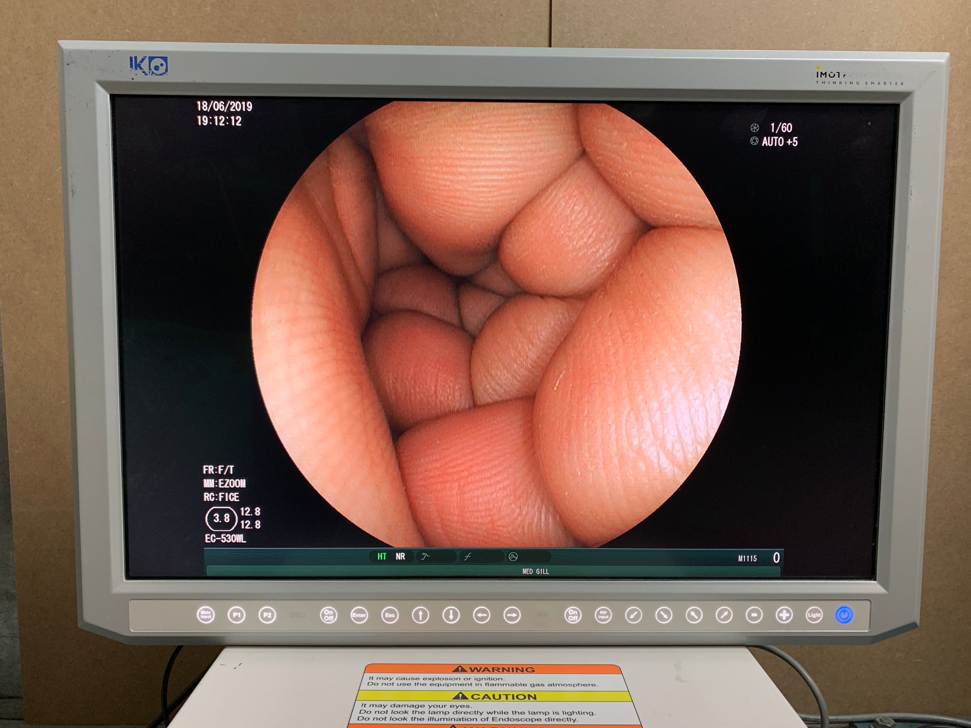 Monitor Widest field of view available in a colonoscope, 170 degrees Full screen display size give superior image quality